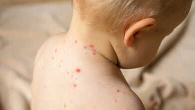 mpox virus us