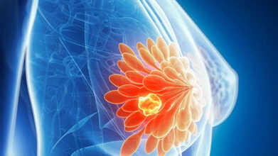 breast cancer awareness cyst tumor
