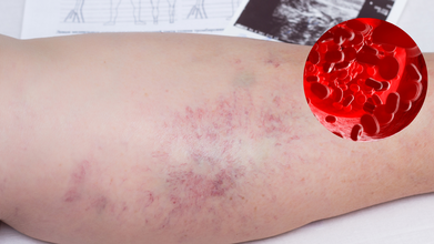 World Thrombosis Day 2025: Theme, Origin, And Significance