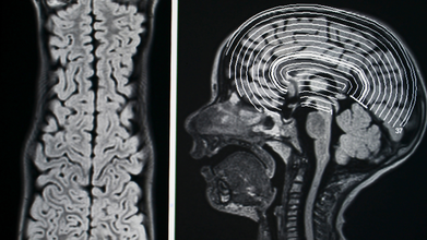 THIS Seizure Could Make You Dance Without Warning