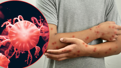 First Locally Acquired Clade 1 Mpox Case Detected California, Symptoms You Should Look Out For