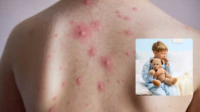 Kollam Faces Chickenpox Outbreak How To Recognize Symptoms Early