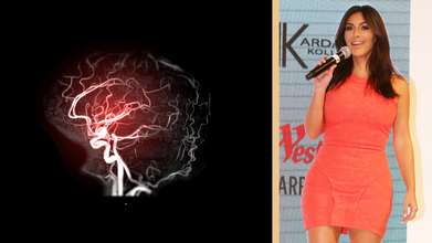 Kim Kardashian's Brain Aneurism Could Be Due To The Stress From Her Divorce With Kanye, More Details Inside