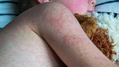 measles outbreak us 2025