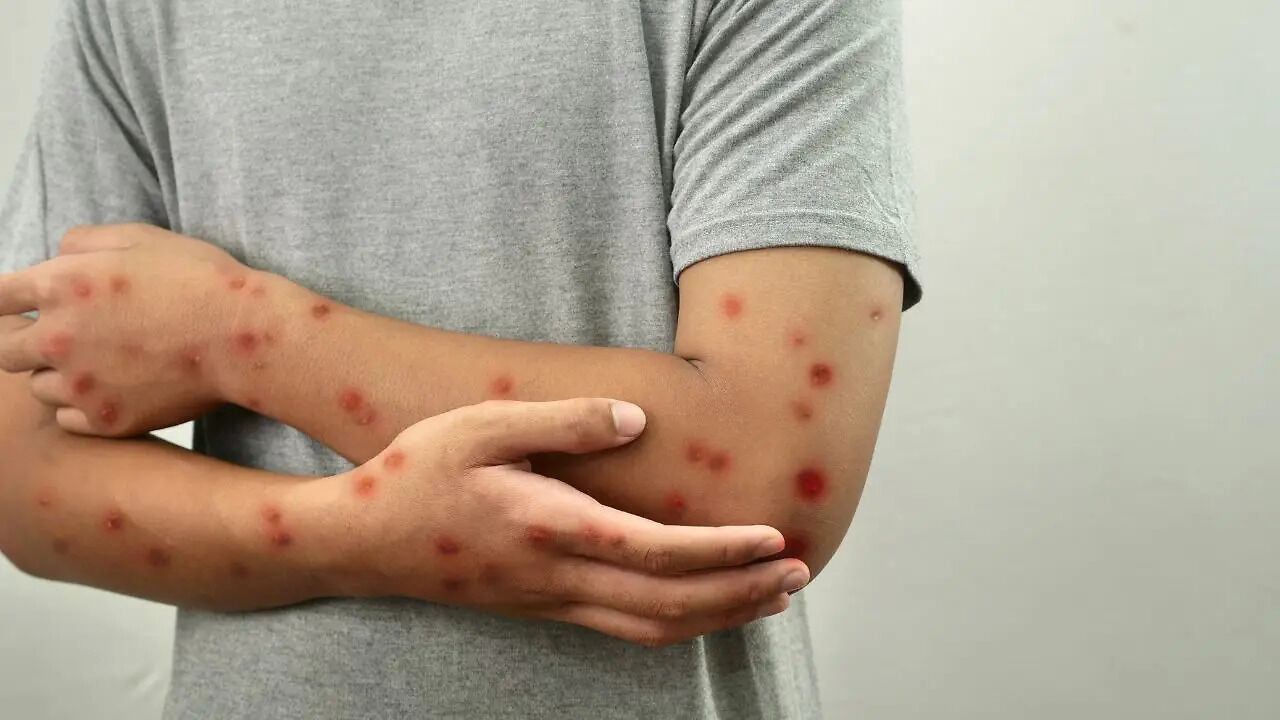 New Mpox Strain Detected in California Sparks Health Alert | Health and Me
