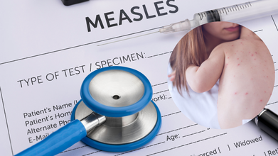 Measles Outbreak: Cases Surge In South Carolina; After US, Canada's Elimination Status Too Could Be Threatened