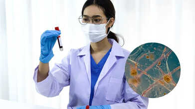 fungal infection london hospital