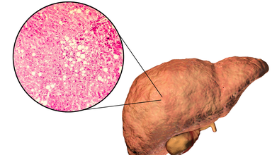 Is There A Way To Detect Fatty Liver Without A Blood Test? Doctor Says Yes