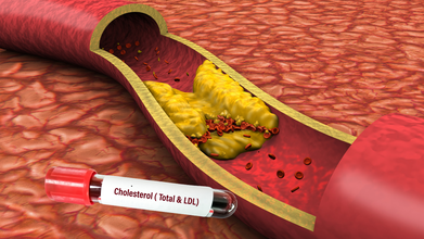 Breakthrough: Gene Editing Jab Dramatically Lowers Harmful Cholesterol Levels In First Trial