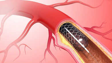 laser angioplasty