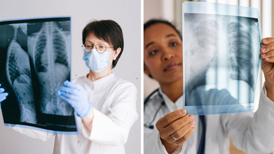 How 26,000 Lives Could Be Saved Each Year With Just One Change to Lung Cancer Screening