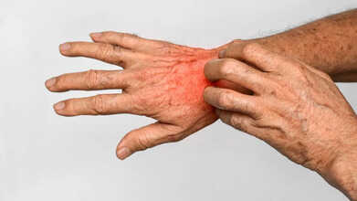 victorian skin disease scabies uk