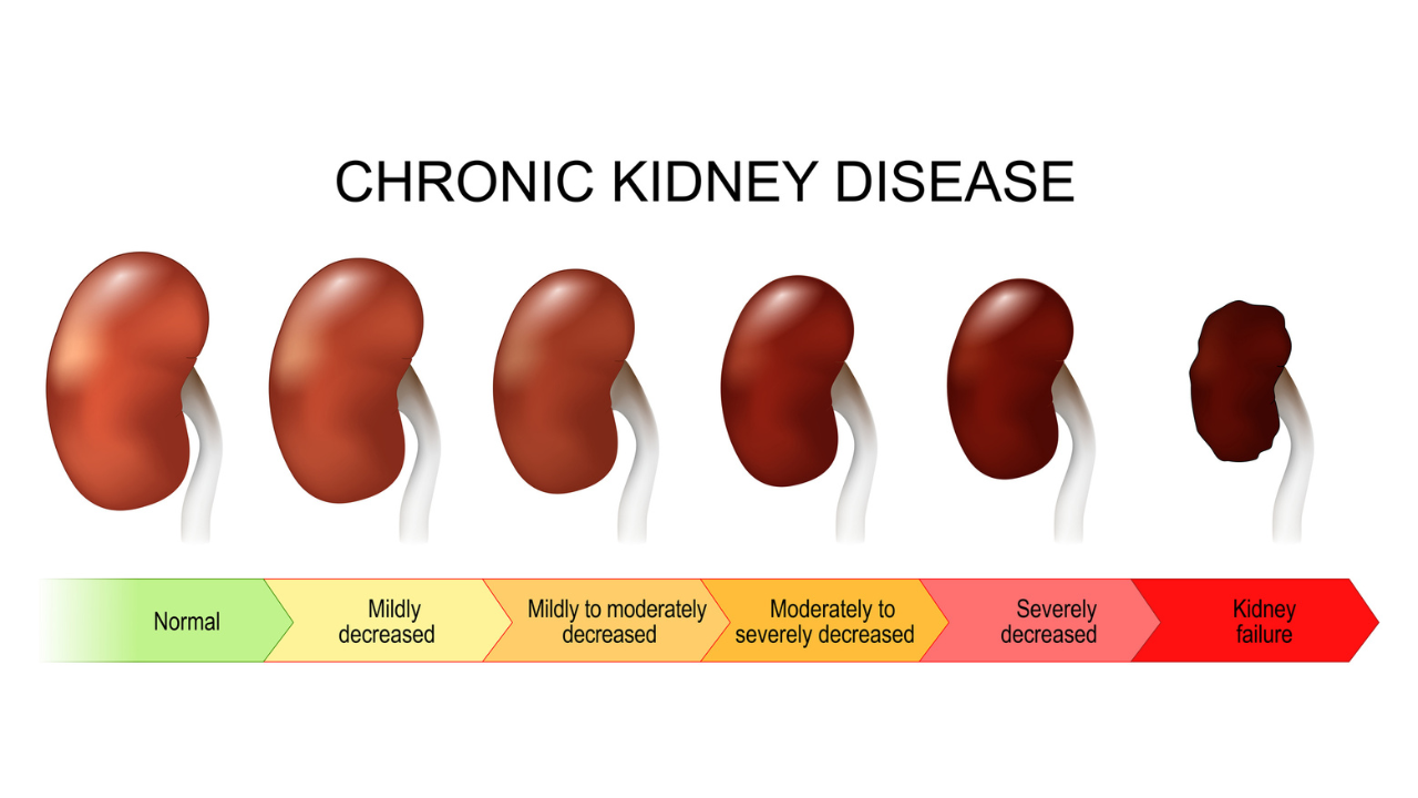 India Has The Second Highest Case Of Chronic Kidney Disease, Doctor Says Early Detection Could Help