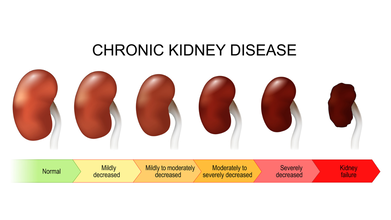 India Has The Second Highest Case Of Chronic Kidney Disease, Doctor Says Early Detection Could Help