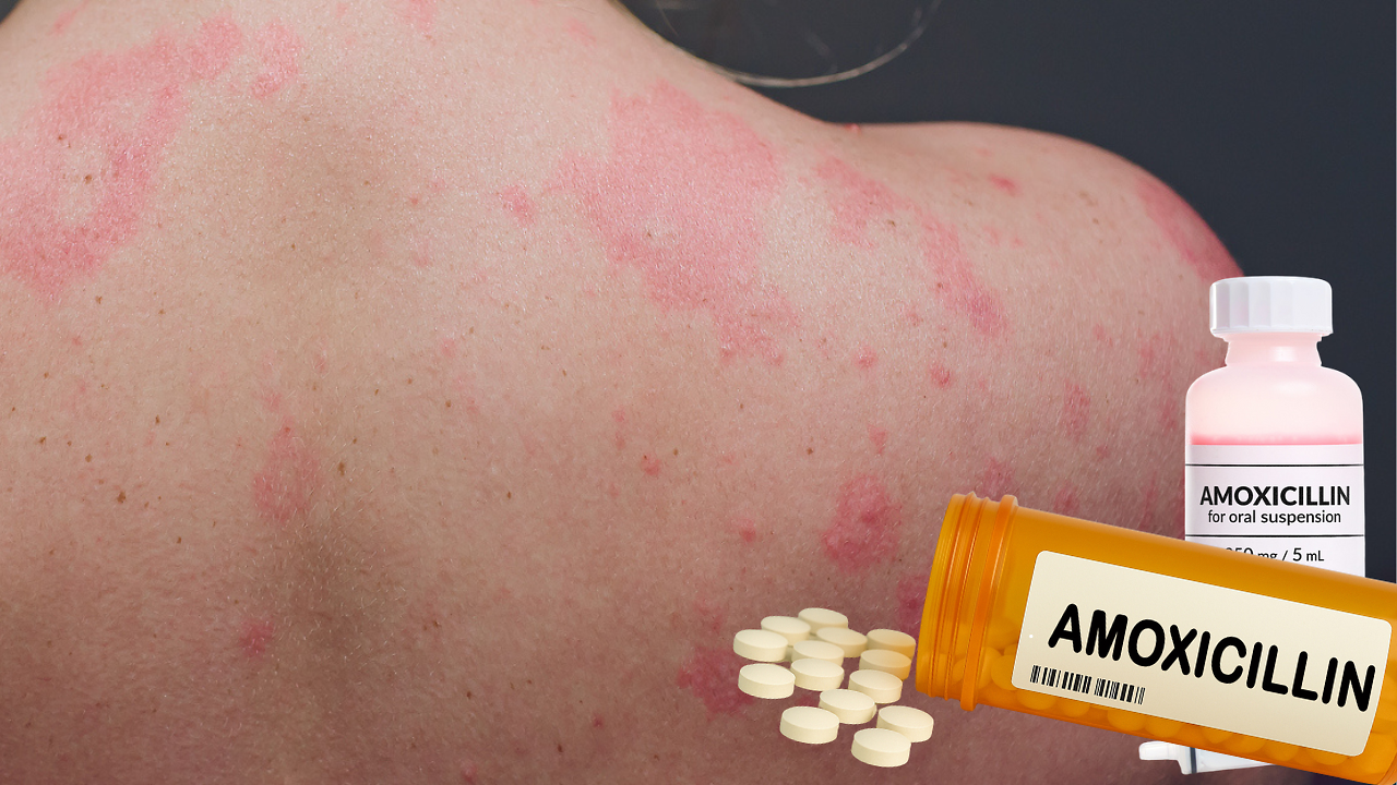 Amoxicillin Rash Adults Face