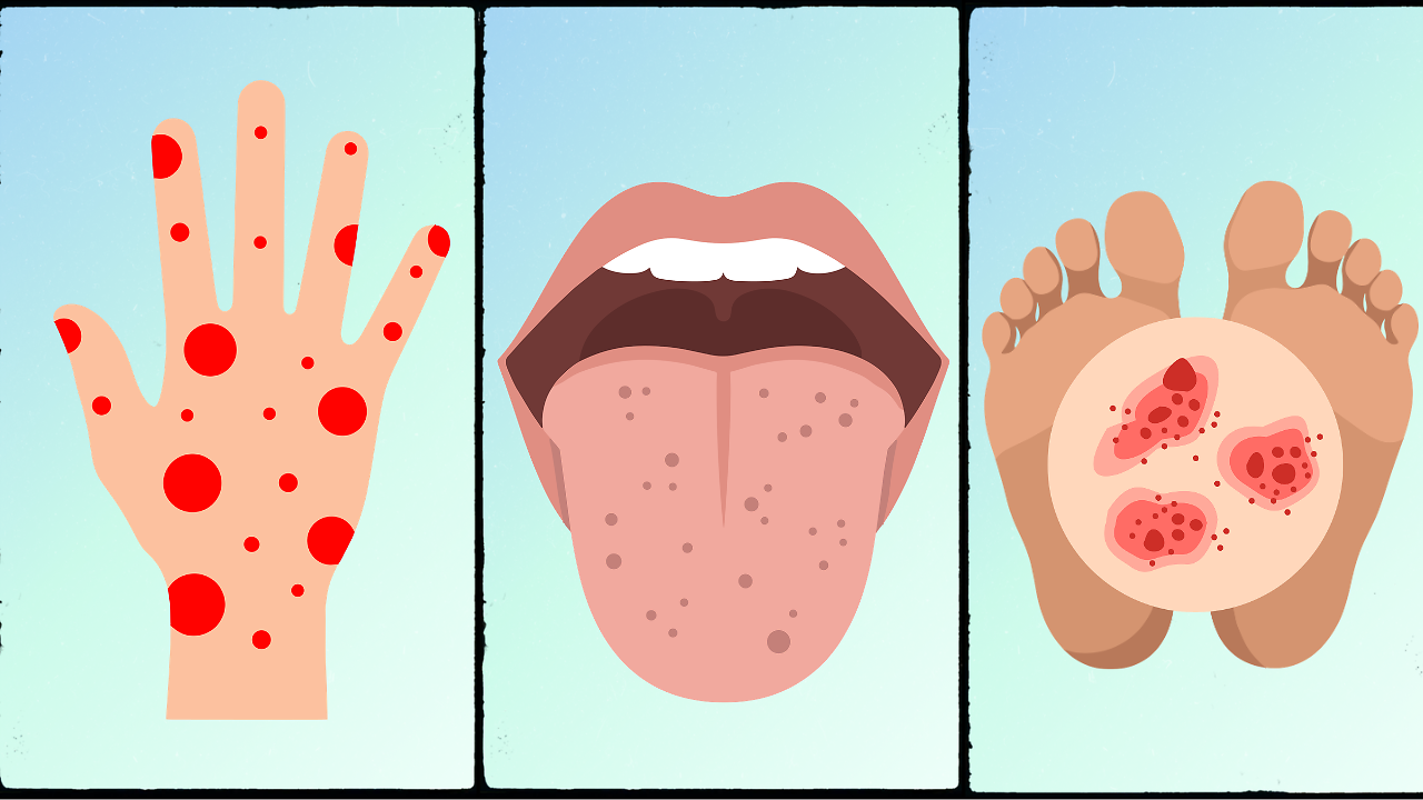 Meningitis Outbreak: How to Differentiate The Symptoms From a Common ...