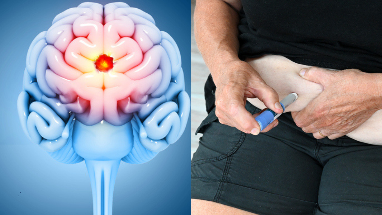 can semaglutide cause a stroke Is Ozempic (Semaglutide) Lower the Risk of Dementia? Does Semaglutide Reduce the Risk
